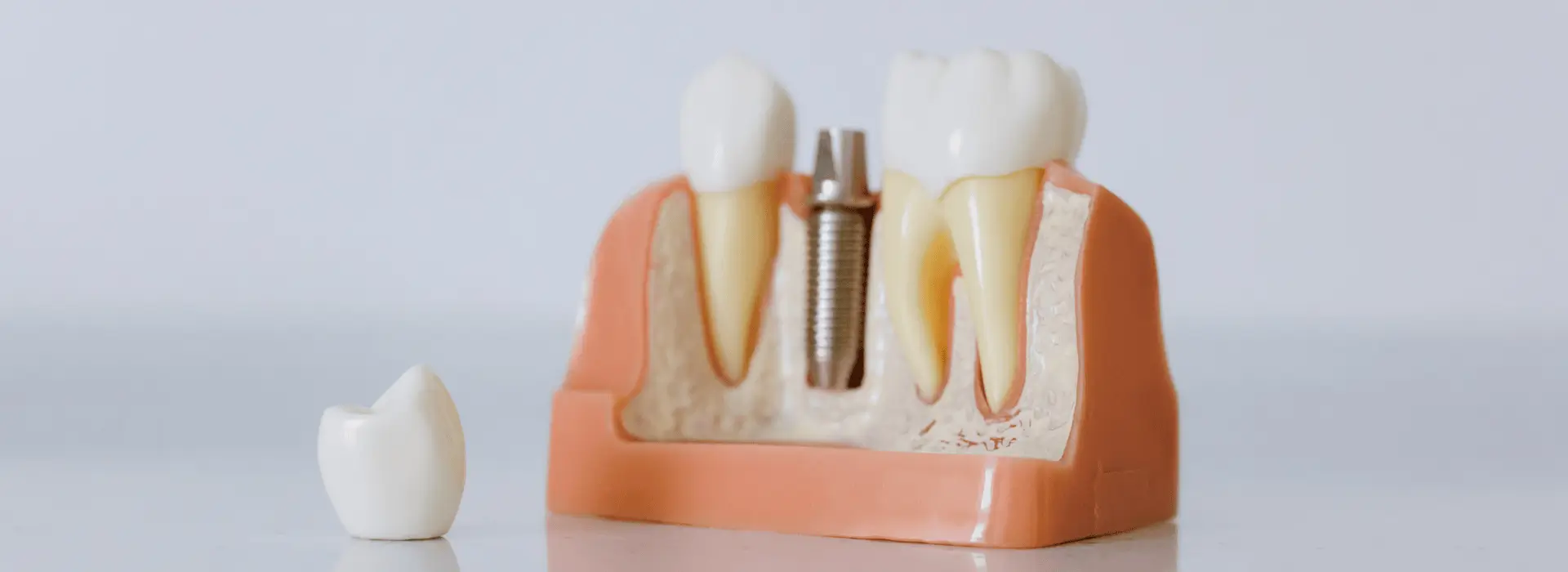 What are the 3 Stages of Dental Implants?