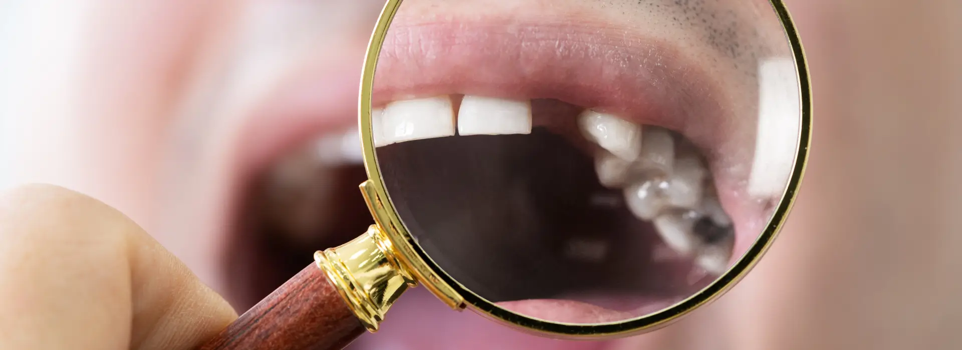 The Hidden Dangers of Dental Implants That Could Cost You Thousands