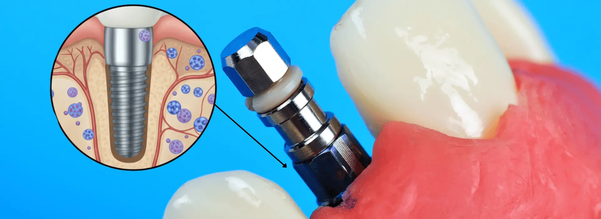 Do Titanium Dental Implants Cause Cancer