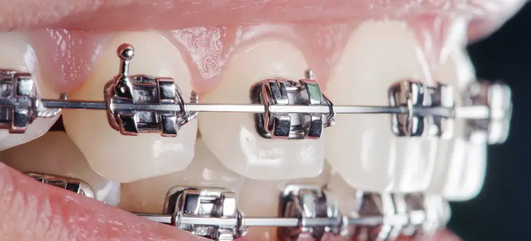 Who Might Need Braces_ Understanding Orthodontic Problems