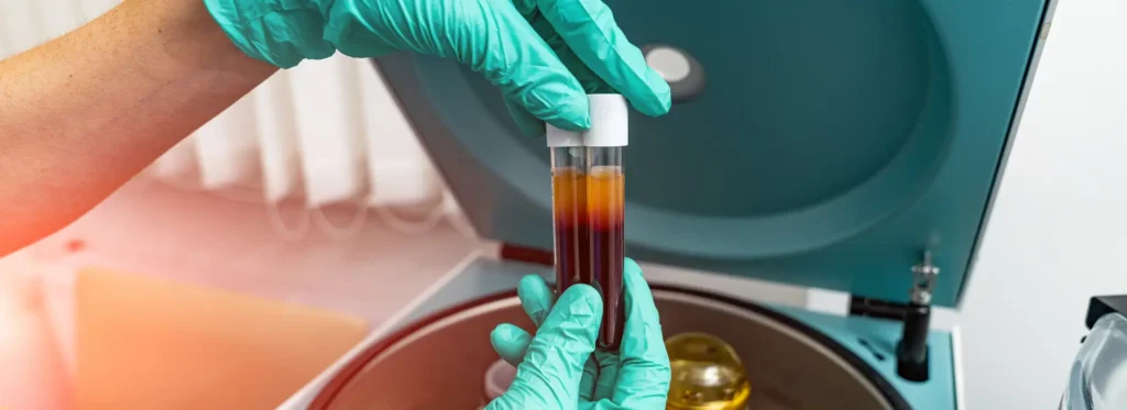 Platelet-Rich Plasma Therapy