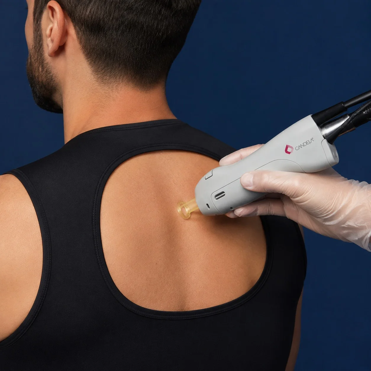 Half Back Laser Hair Removal