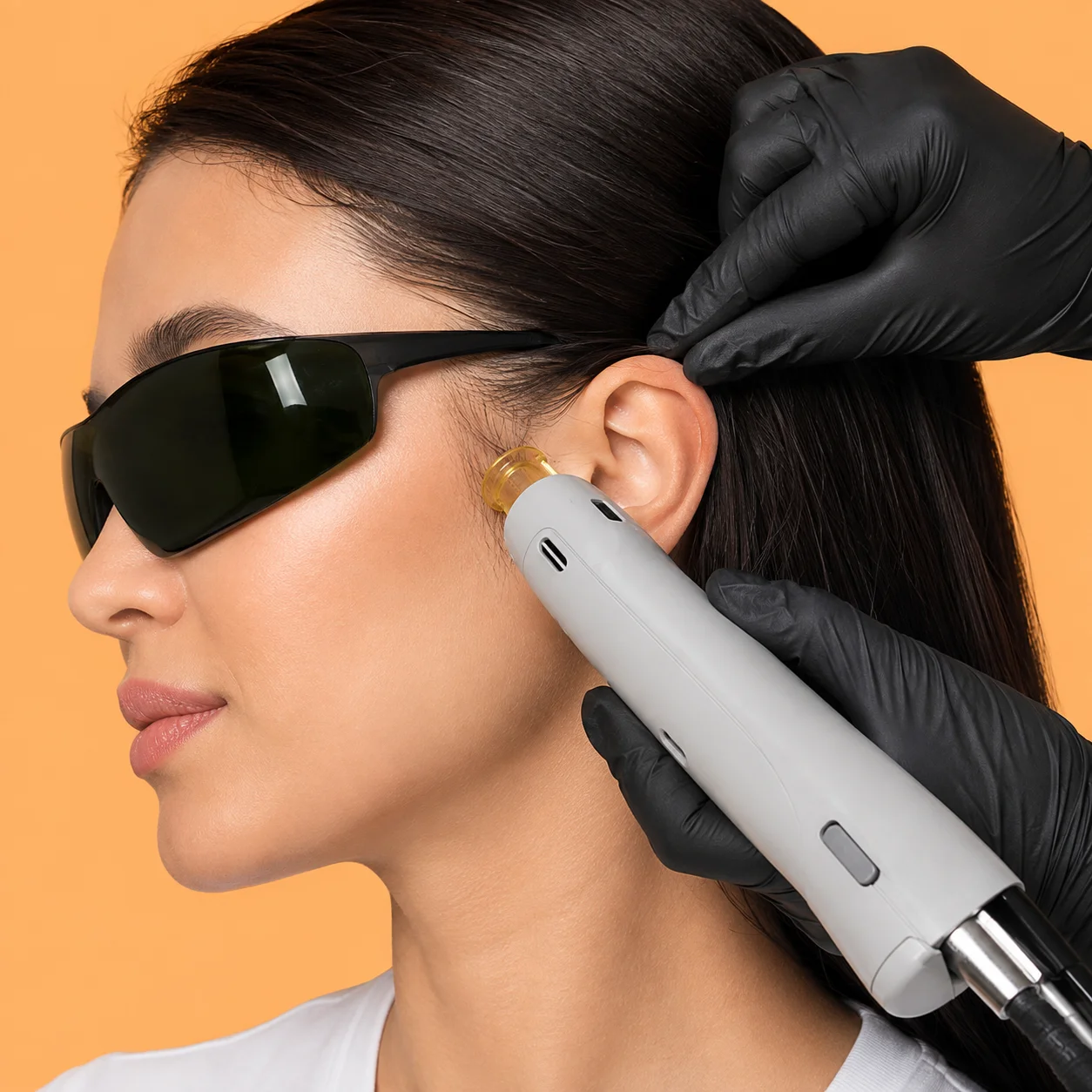 Side Burns Laser Hair Removal